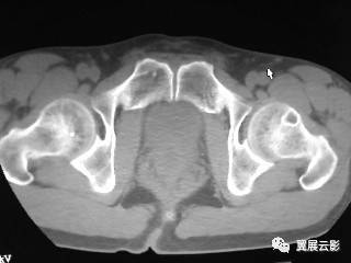 股骨颈疝窝的ct及mri诊断