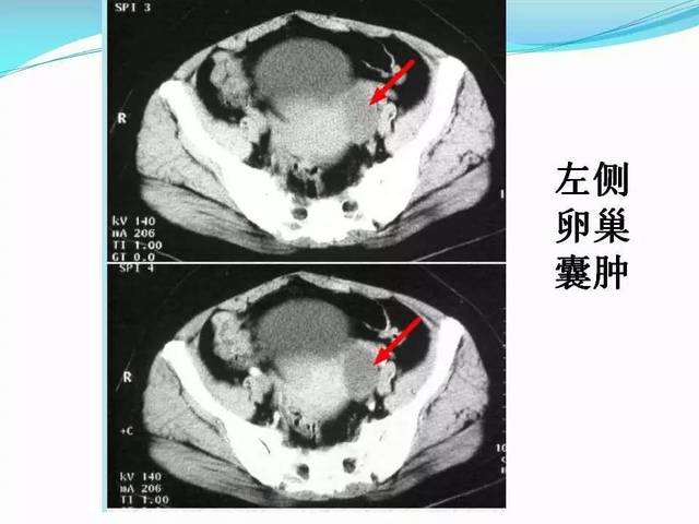 卵巢囊肿影像诊断及鉴别诊断