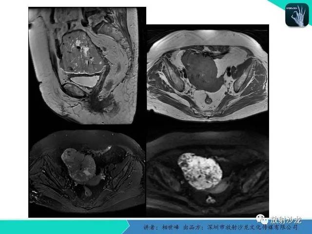 【專家大講堂】女性盆腔非生殖系統腫瘤 的mri診斷