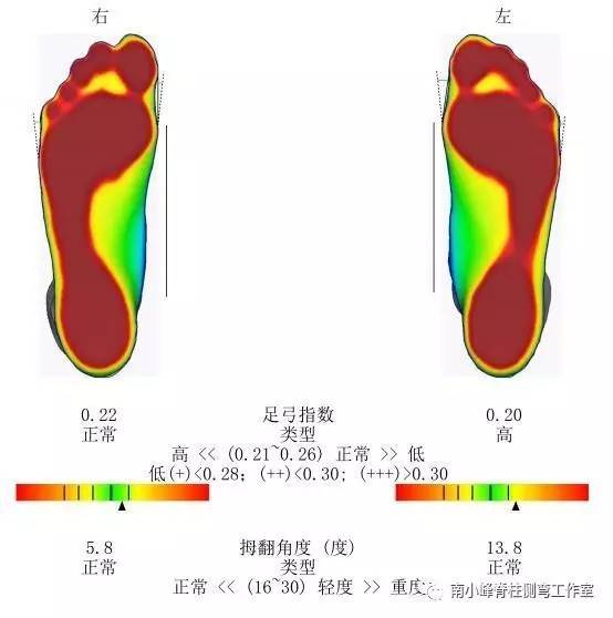 脊柱侧弯孩子足部畸形不容忽视