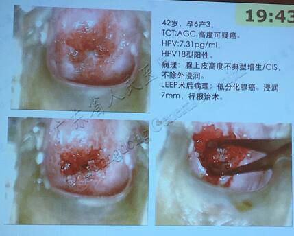 宫颈癌宫颈口图片图片