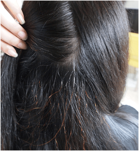 白发怎么治疗能变黑发