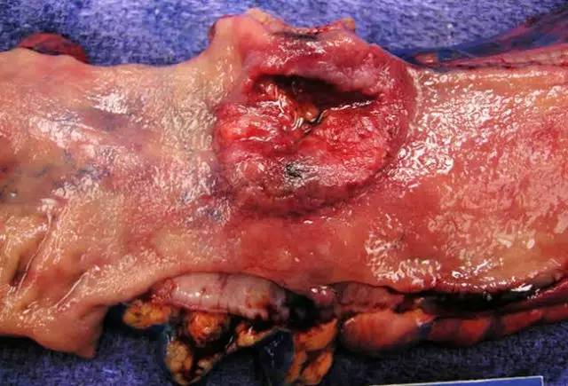大肠腺癌大体标本描述图片
