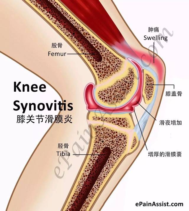 症状:膝盖的滑膜炎,多数会出现 轻微肿胀,疼痛 走路有时会 咯噔咯噔