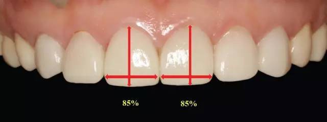 图27 中切牙牙冠宽长比