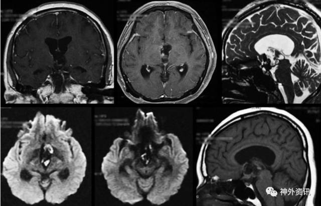 三脑室肿瘤图片