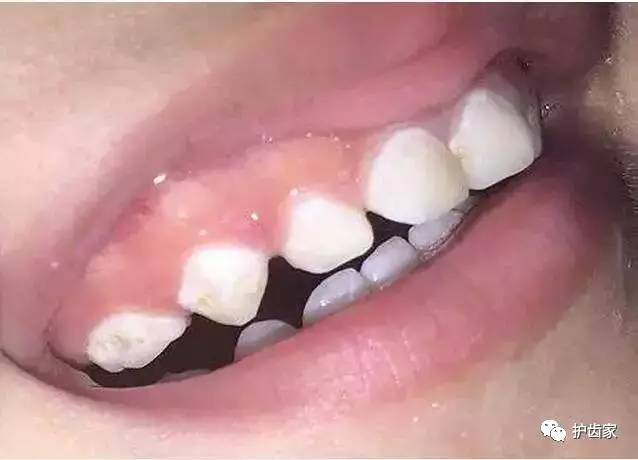 早期的脱矿可以通过用含氟牙膏刷牙,涂氟,使用护牙素等手段帮助牙齿再