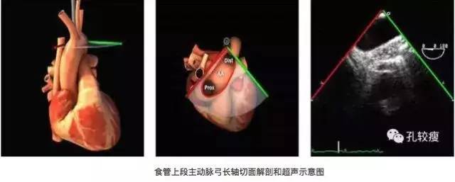 手把手教你做经食管超声心动图 (精美图文教学)