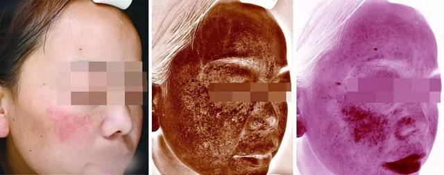 脸部长斑原因分布图图片