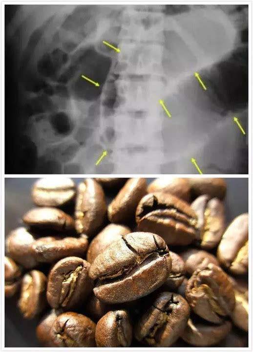 肠梗阻咖啡豆征图片图片
