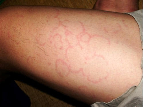 链球菌感染性皮疹图片图片