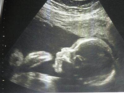 孕17周胎儿图片