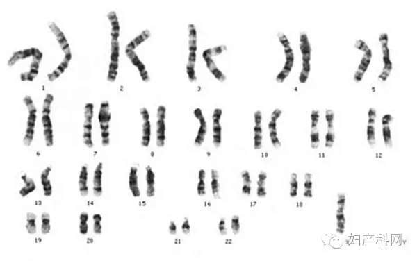 【病例问答】no29turner综合征所致原发闭经的诊治