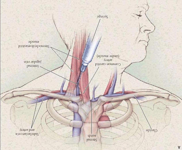 经b超引导颈内静脉置入picc管在临床中的应用