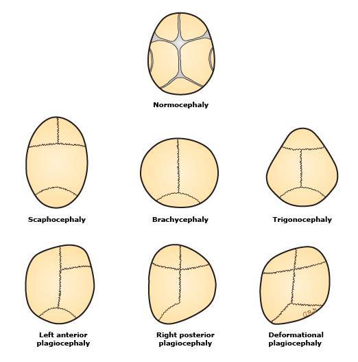 不同颅缝早闭的类型 其中舟状头(图3,也被称为船体形状的头骨,是由矢