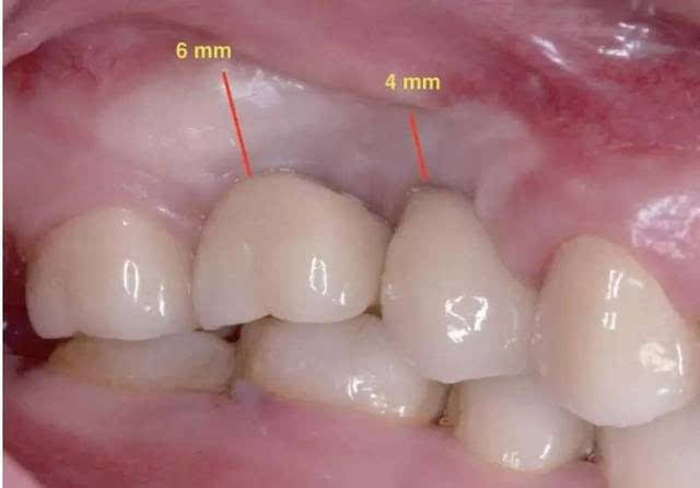 种植二期可见膜龈联合接近牙槽嵴顶(图30),行游离龈瓣移植加宽角化