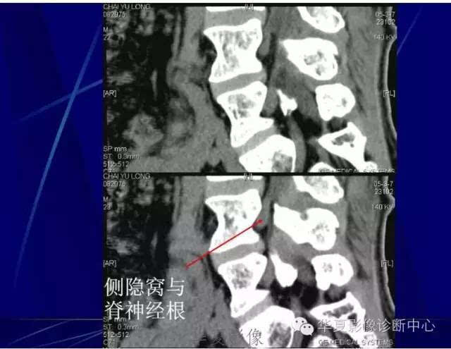 詳細的腰椎解剖,椎間盤突出,膨出,看這裡