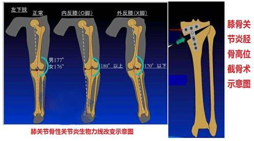 医文医话方锐胫骨上段高位截骨术早期膝骨关节炎患者的福音