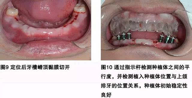 並觀察與上頜導板所示牙位的頰舌側位置關係,植入6顆奧齒泰(osstem)