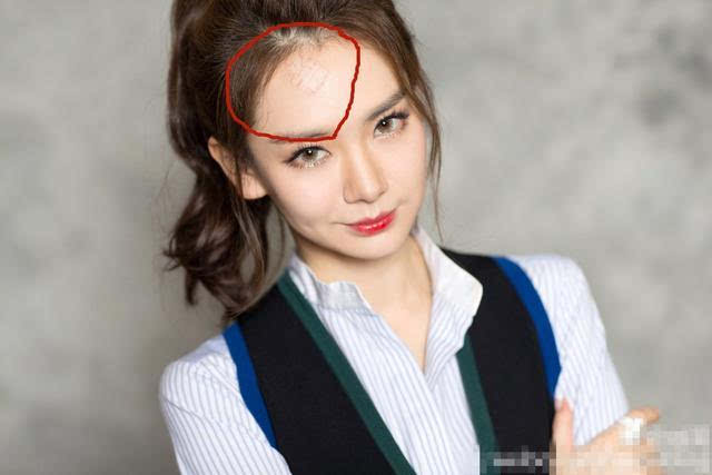 因为拍戏受伤还因此上过热搜,但是因此戚薇也在额头上留下了一个疤痕
