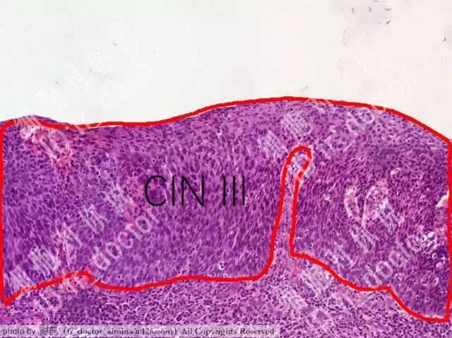 显微镜下的宫颈cin病变:风险程度高的癌前病变