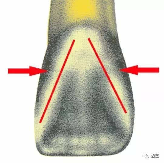 二)近远中边缘嵴长度的对比 近中边缘嵴长于远中边缘嵴