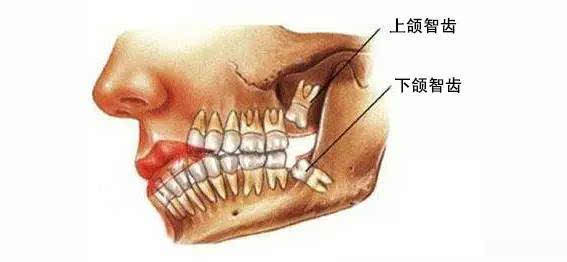 有的阻生智齒會暴露一部分在口中,有時舌頭能舔到;而有的完全被牙齦