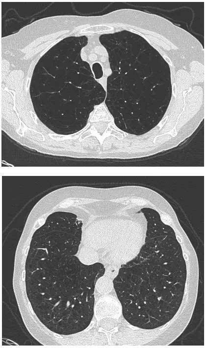 怎样看肺气肿ct图片图片