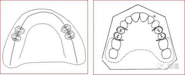 肯氏三类义齿设计图片图片