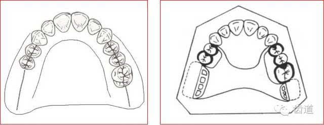 二)肯式(kennedy)第二类设计 1,概念 牙弓一侧后部牙缺失,远中为游离