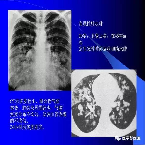 肺水肿的影像学表现