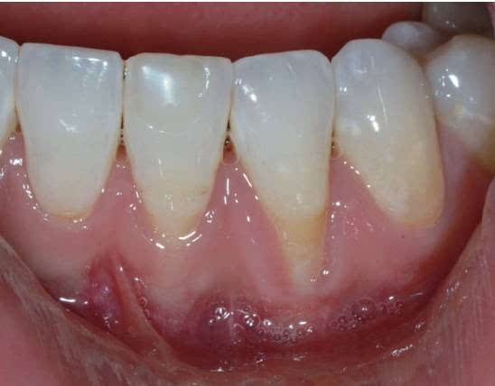 图14 右下侧切牙牙龈萎缩,附着龈丧失