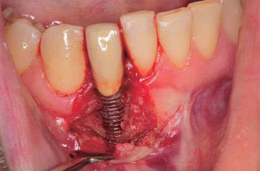 图26 翻瓣后发现骨缺损,种植牙牙周炎
