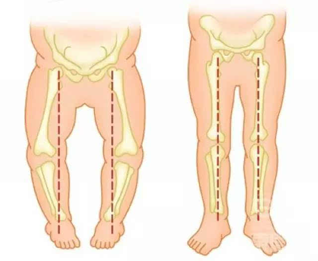 O型腿是怎么形成的图片