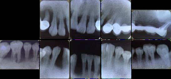 口腔跨学科治疗中的规范化牙周治疗程序——一例重度慢性牙周炎患者的