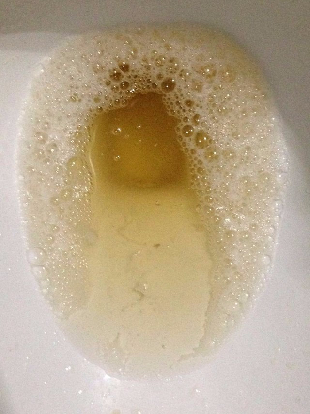 正常人的尿泡沫尿液图片