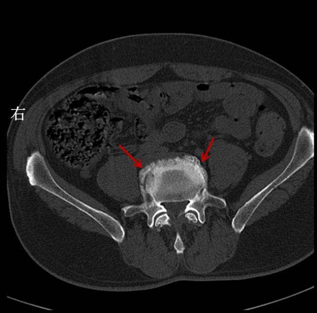 腰椎骨质增生ct图片
