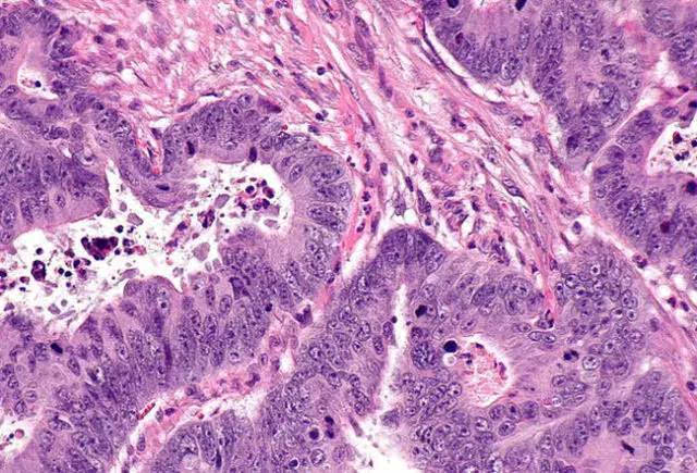 结肠癌显微镜图片图片