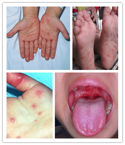 儿童口疱疹症状和图片图片