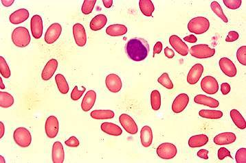 椭圆形红细胞图片