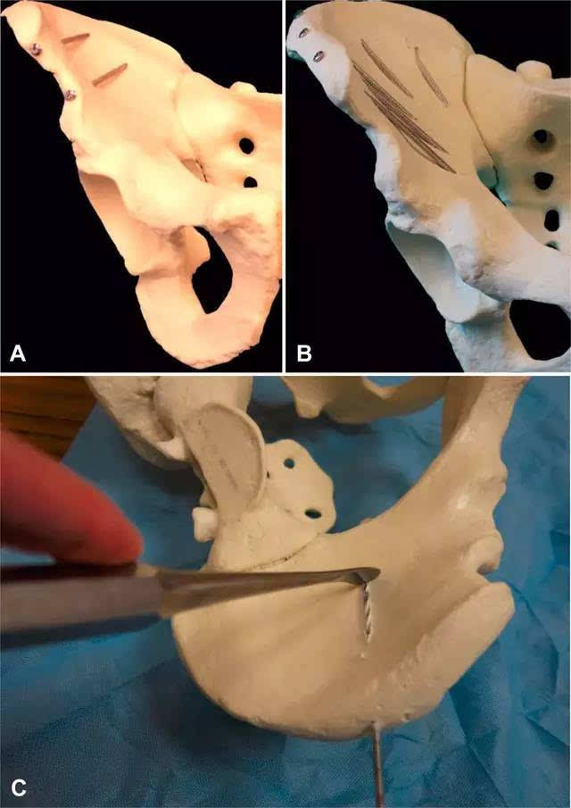 手术技巧:3 步教你「切割螺钉」固定髂骨翼骨折