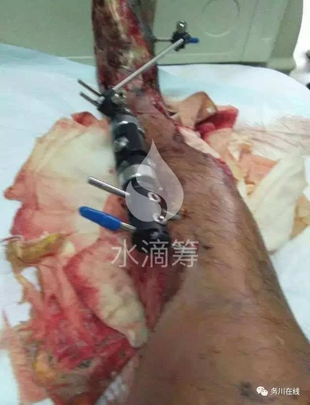 截肢残肢双腿图片