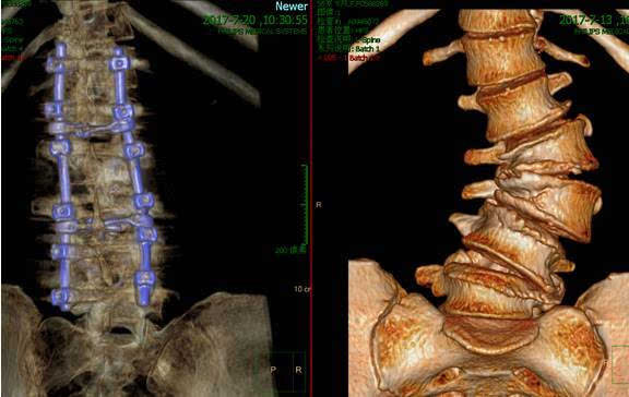 术后三维ct重建显示 腰椎严重侧弯畸形