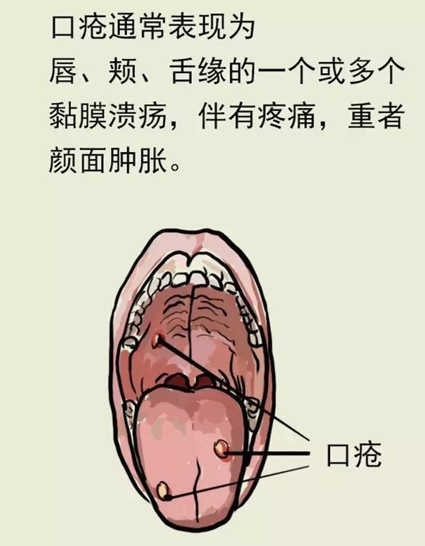 口腔溃疡一直不愈合,不是因为上火,而是因为