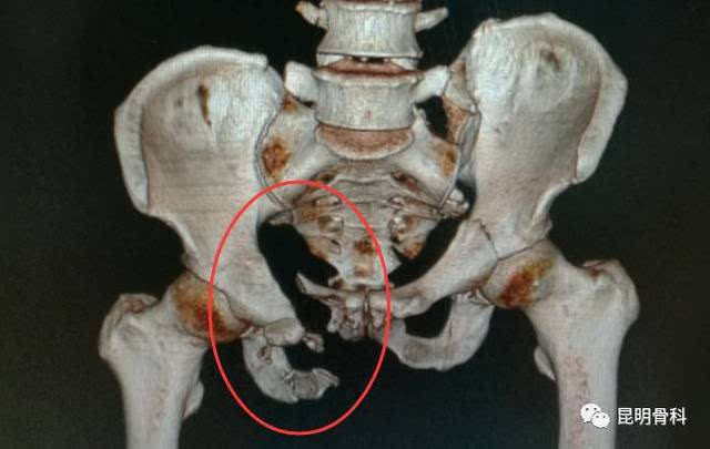 男性骨盆骨折图片
