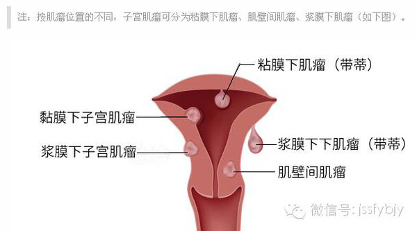 子宮肌瘤根據部位可以分為:粘膜下,肌壁間和漿膜下子宮肌瘤三種類型.