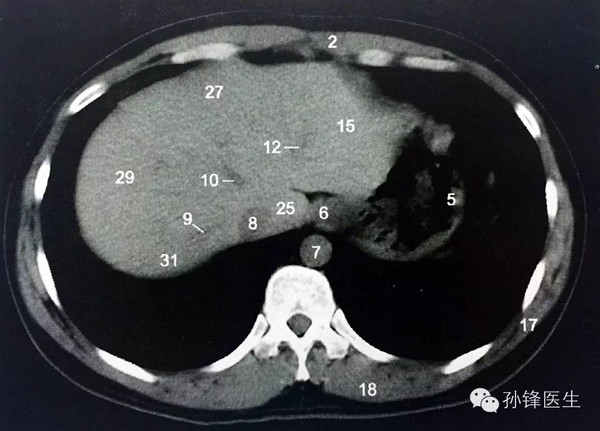 第二肝门横断层解剖图图片
