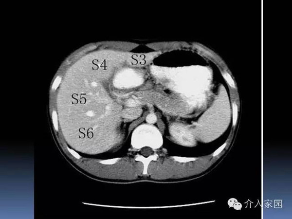 肝脏ct解剖图谱图片