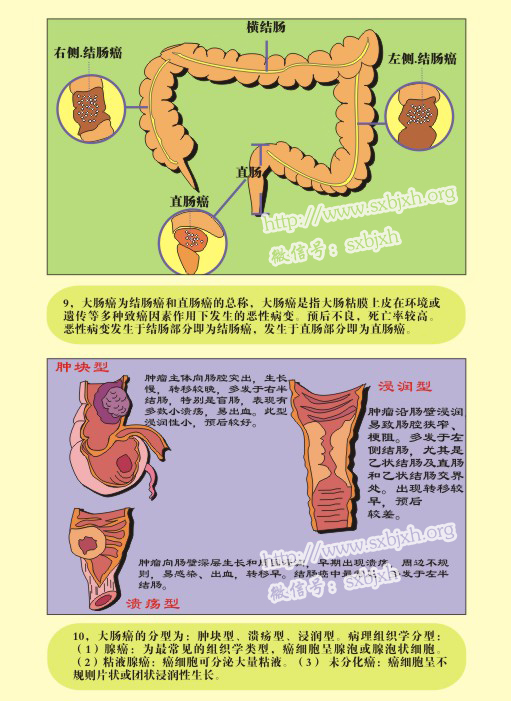 肠癌的演变过程图片图片