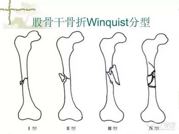 股骨干骨折位置图片图片